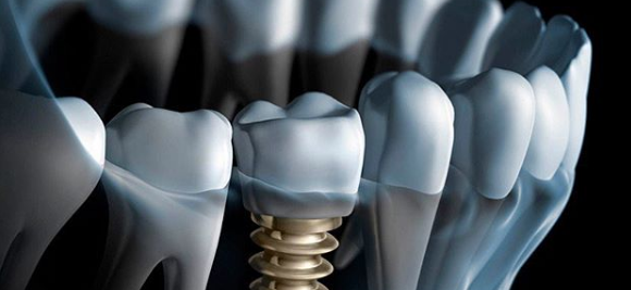 implante dentário Prosorriso salto