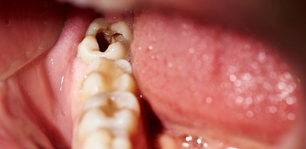 Bactérias da boca podem provocar infecção grave no cérebro, como de Renata Banhara