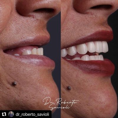 implante-dentaro-resultado-dr-roberto-02