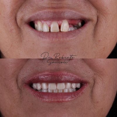 implante-dentaro-resultado-dr-roberto-03