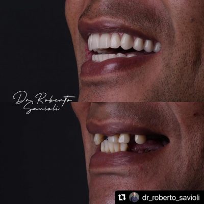 implante-dentaro-resultado-dr-roberto-06