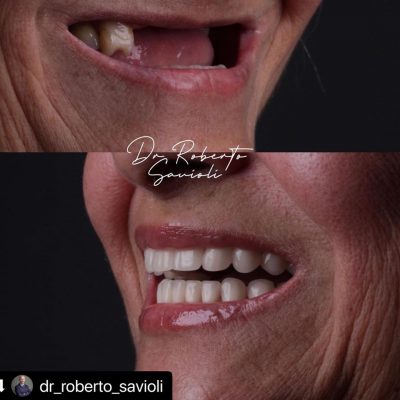 implante-dentaro-resultado-dr-roberto-08